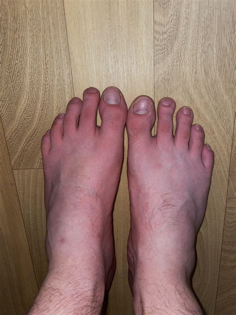 Raynauds Disease: Feet Pictures,。